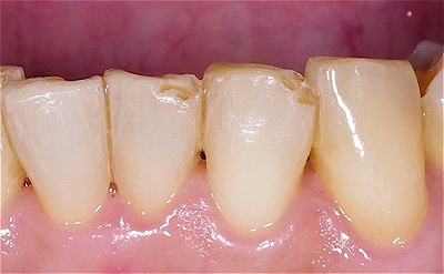 咬合による前歯磨耗その４ー３.jpg