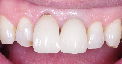 歯ブラシによる歯ぐきの退縮１－１.jpg