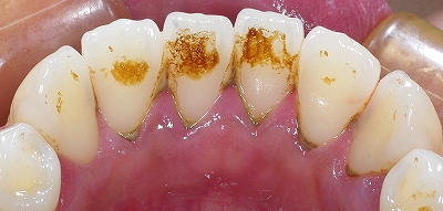 歯石除去下顎前歯１.jpg