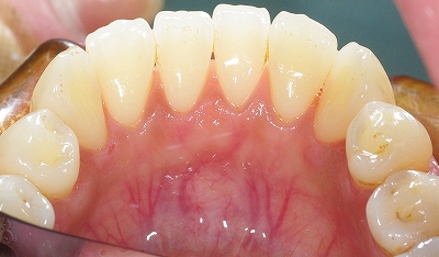 歯石除去下顎前歯２.jpg