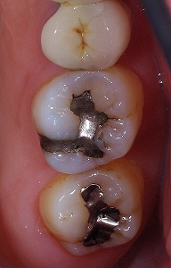 右上第一大臼歯AFC２－１.jpg