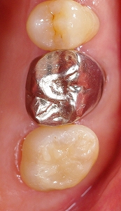 右上第二大臼歯ＣＲ－２.jpg
