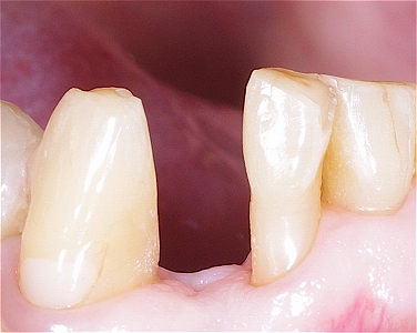 下顎前歯接着性ブリッジ１.jpg