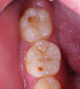 下顎大臼歯裂溝う触２.jpg