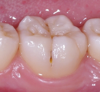 下顎第一大臼歯頬側裂溝側面.jpg