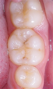 下顎第一大臼歯裂溝う触１.jpg
