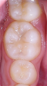 下顎第一大臼歯裂溝う触３.jpg