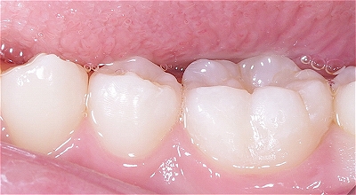 下顎第一大臼歯裂溝う触４.jpg