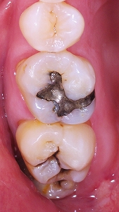 金属イオンは歯を黒くする１.jpg