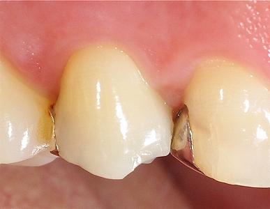 金属インレーの不適合２－１.jpg