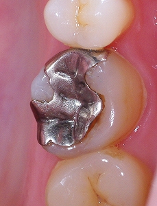 金属と歯のすき間.jpg