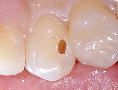 検診で見つかった小さな虫歯.jpg