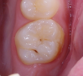 検診で見つかった小さな虫歯？その２－１.jpg