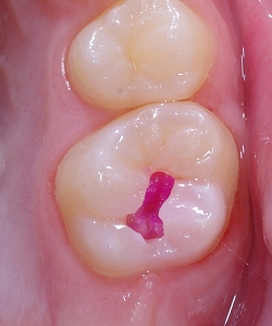 検診で見つかった小さな虫歯その２－２.jpg
