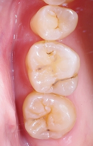 上の奥歯の溝にできた虫歯 あき歯科医院の医院ブログ