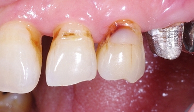歯頚部虫歯をＣＲ充填３－１.jpg