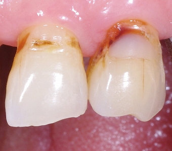 歯頚部虫歯をＣＲ充填３－２.jpg