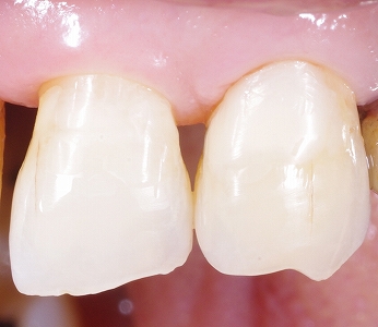 歯頚部虫歯をＣＲ充填３－３.jpg
