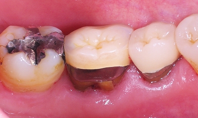 歯根破折による歯ぐきから出血２.jpg