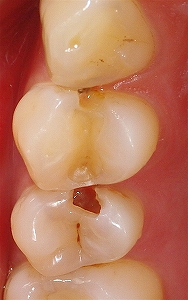 歯質温存治療１.jpg