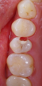 歯質温存治療２.jpg