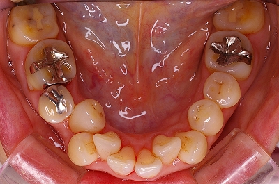 歯列不正による虫歯１.jpg