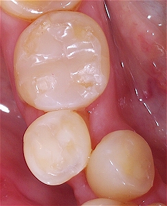 歯列不正による虫歯３.jpg