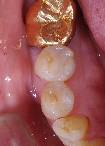 小臼歯2本を白い歯に４－２.jpg