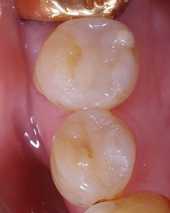 小臼歯2本を白い歯に４－４.jpg
