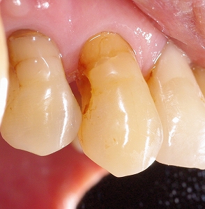 上顎犬歯側面の虫歯.jpg