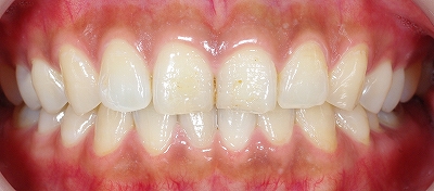上顎前歯のエナメル質磨耗１.jpg