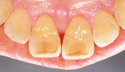 上顎前歯先端の虫歯１.jpg