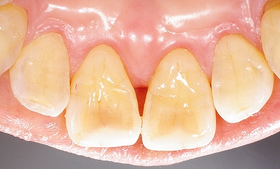上顎前歯先端の虫歯２.jpg