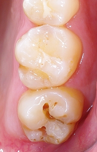 上顎第二大臼歯の虫歯２.jpg