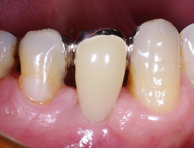 接着性ブリッジ、舌側金属４.jpg