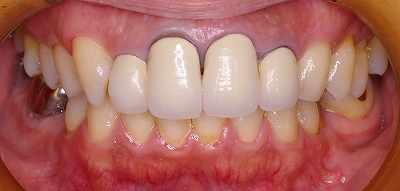 前歯のクラウン脱離３－１.jpg