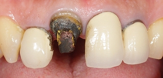 前歯のクラウン脱離３－２.jpg