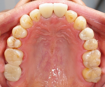 上顎全ての歯セラミック白く２－２.jpg