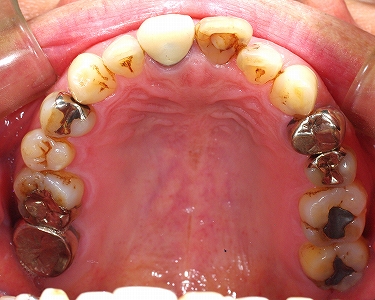 上顎全ての歯セラミック白く２－１.jpg