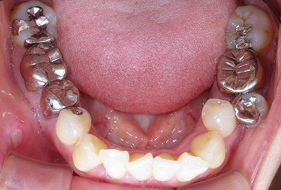 第二小臼歯頬側転移１.jpg