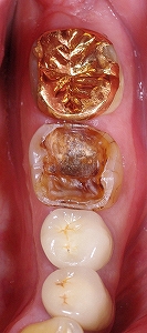 茶色の虫歯をセラミッククラウンに１.jpg