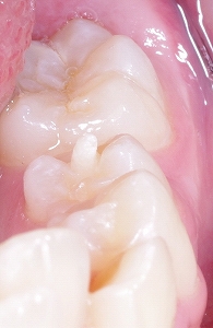 中心結節、下顎第二小臼歯１.jpg
