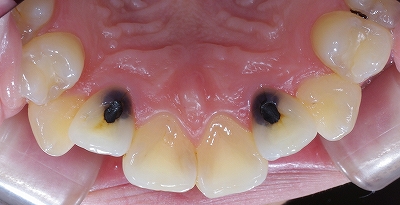 虫歯になり易い部位その３－１.jpg