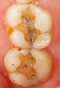虫歯の奥に破折線１.jpg