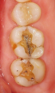 虫歯の奥に破折線２.jpg