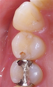 虫歯を放置したために進行した症例２.jpg