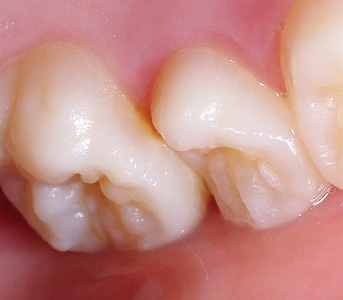 萌出直後の永久歯の溝の深さ側面.jpg