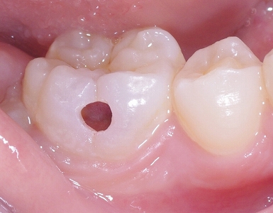 虫歯の治療 あき歯科医院の医院ブログ