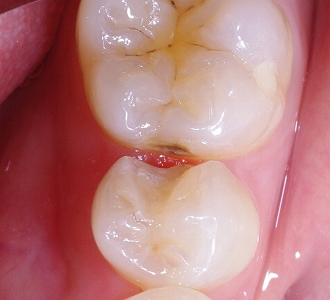 隣接カリエスは両隣にできる術前.jpg