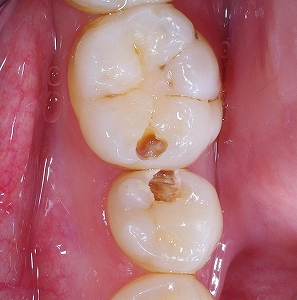 隣接カリエス多数３.jpg